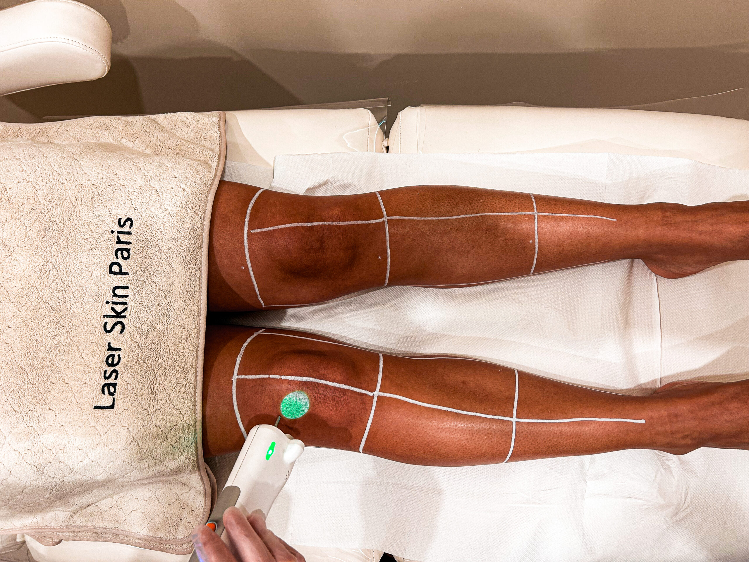 Appareil laser Clarity II utilisé pour l’épilation définitive à Paris dans le centre Laser Skin Paris