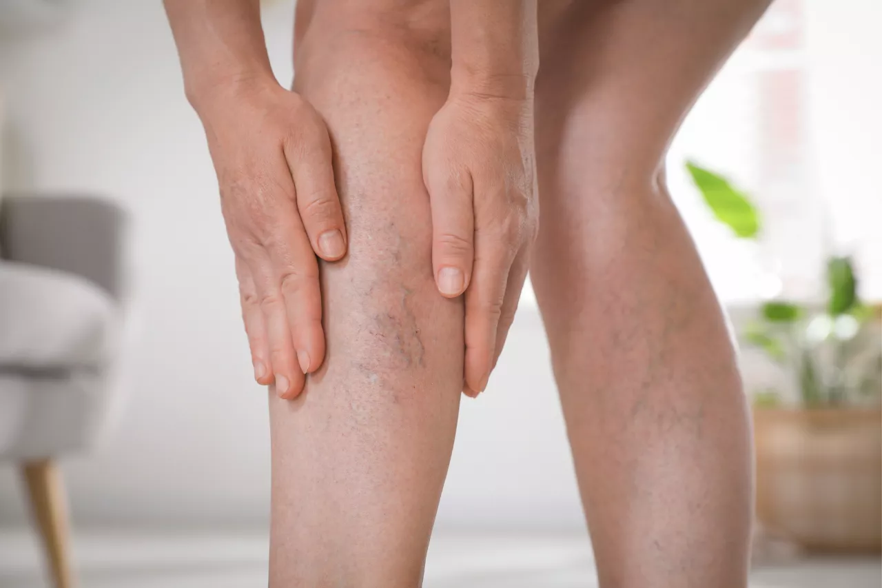 Laser vasculaire, médecine esthétique destiné à atténuer certaines lésions vasculaires visibles, telles que les rougeurs diffuses, la couperose ou les petites varicosités. Chez Laser Skin Paris 75015